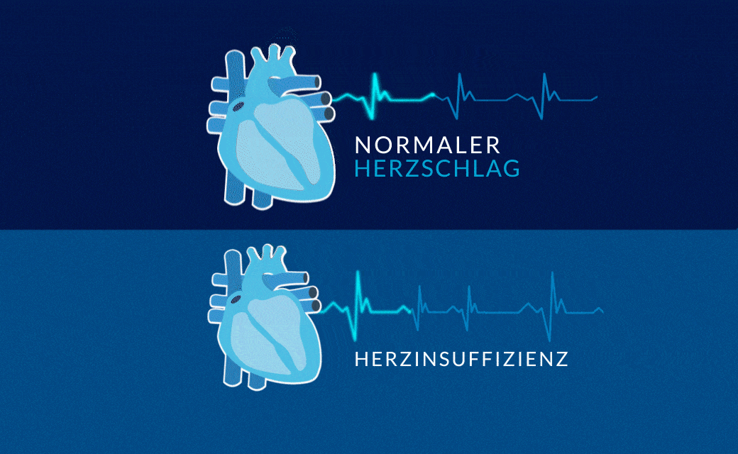 Video, das Herzinsuffizienz simuliert. Hören sie auf ihr herz